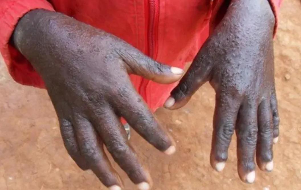 Santé publique : Une dizaine de cas suspects de fièvre charbonneuse à Butembo