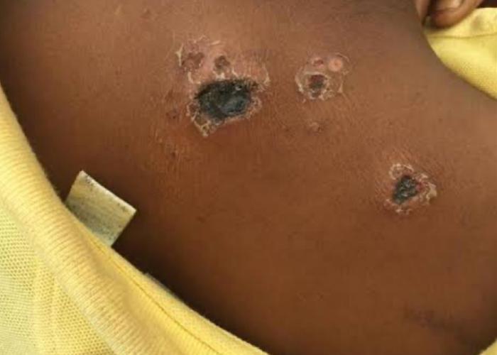 Lubero : Alerte sanitaire après un décès et six cas suspects d’anthrax à Kasalala